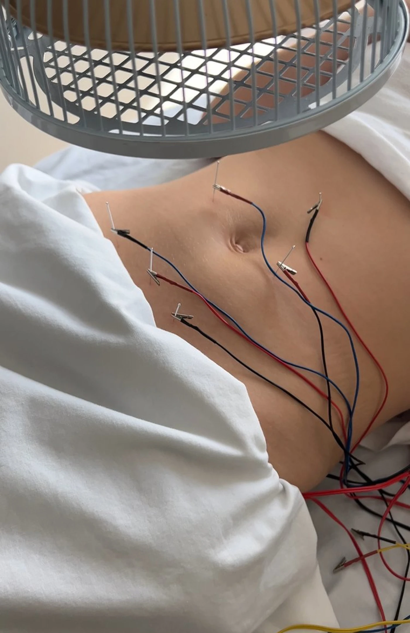 Acupuncture